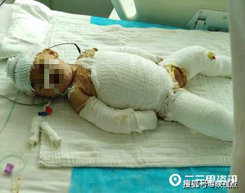 2岁女童跌入开水锅全身烫伤85数百爱心人士纷纷援手筹资