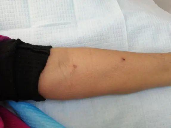 钝针穿刺究竟好在哪里