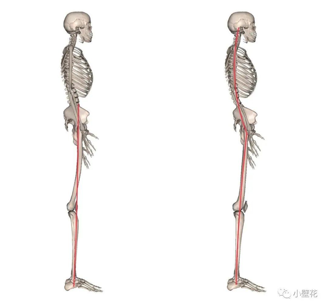 膝超伸,就有可能是足踝膝关节在一条线上,骨盆(髂嵴最高点)依然是前移