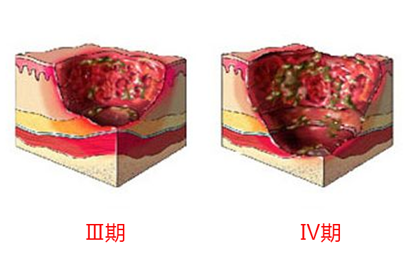 傷迪科普小助手褥瘡的分期症狀