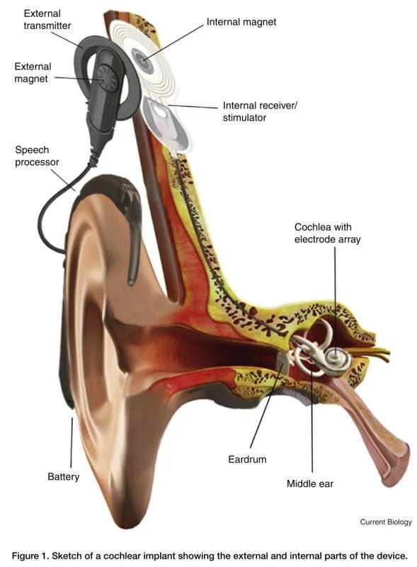 耳蜗电图电极放置图片