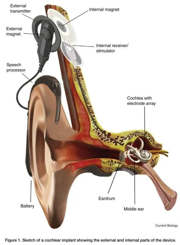 人工耳蜗植入体图片