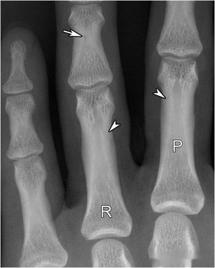 x线诊断要收藏的7个手部正常征象片子