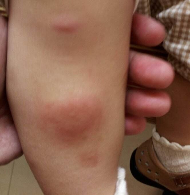 拒绝蚊子发红包澳洲热卖萌爆炸的驱蚊止痒神器一抹消痒祛包