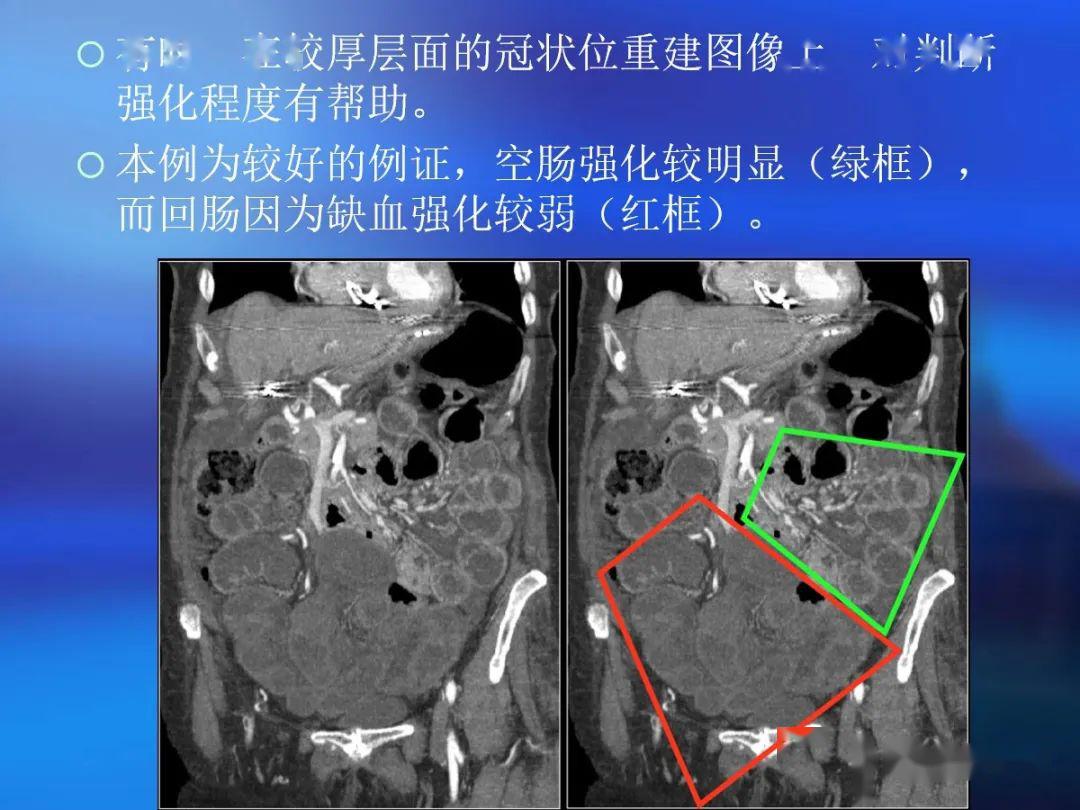 肠道壁增厚ct表现