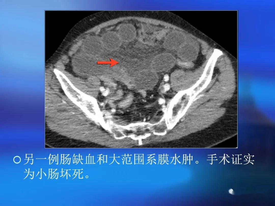 肛门和直肠的CT图图片