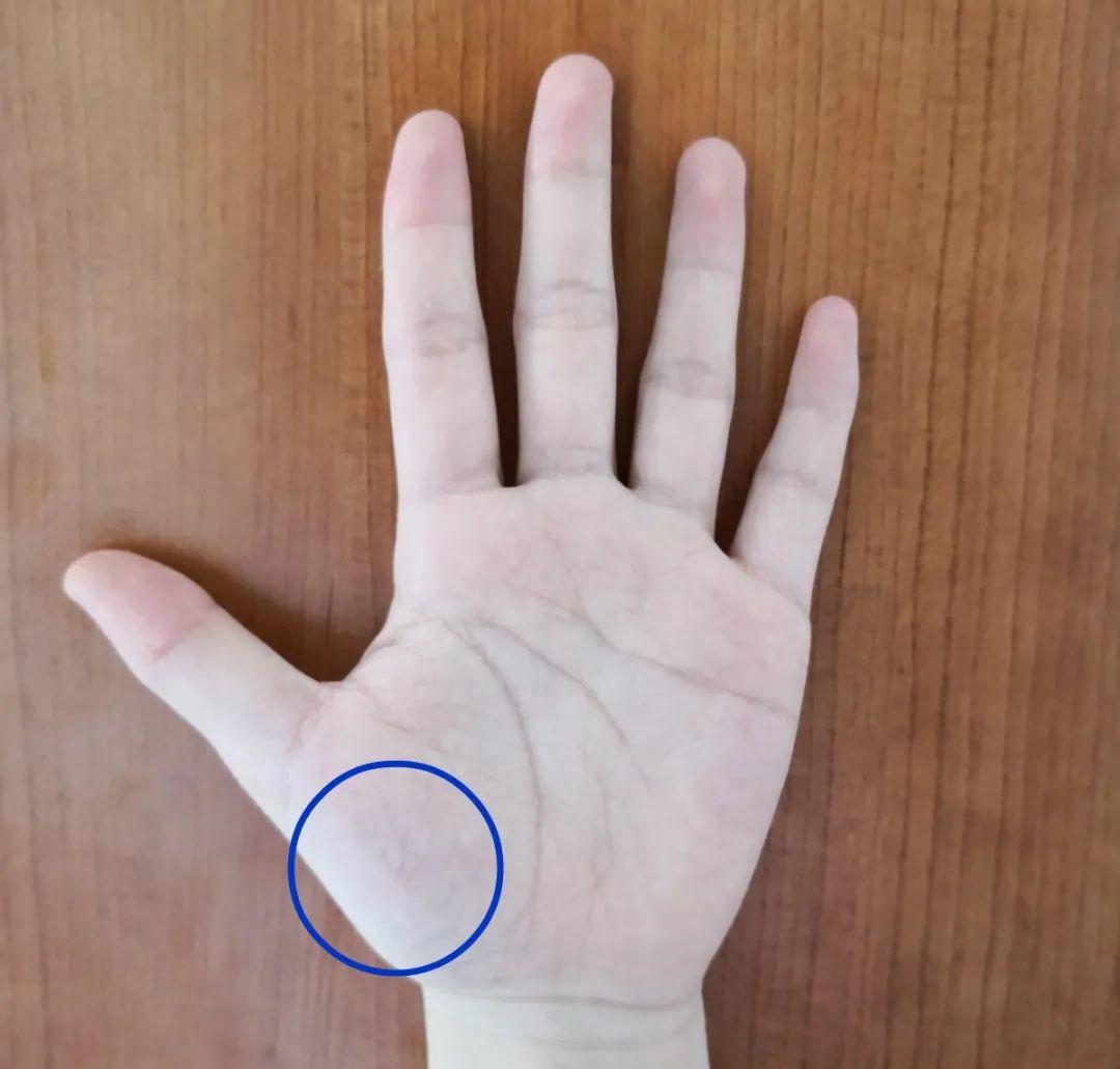 大鱼际青筋,可能预示全身血液循环存在问题,或是存在三高,心脑血管