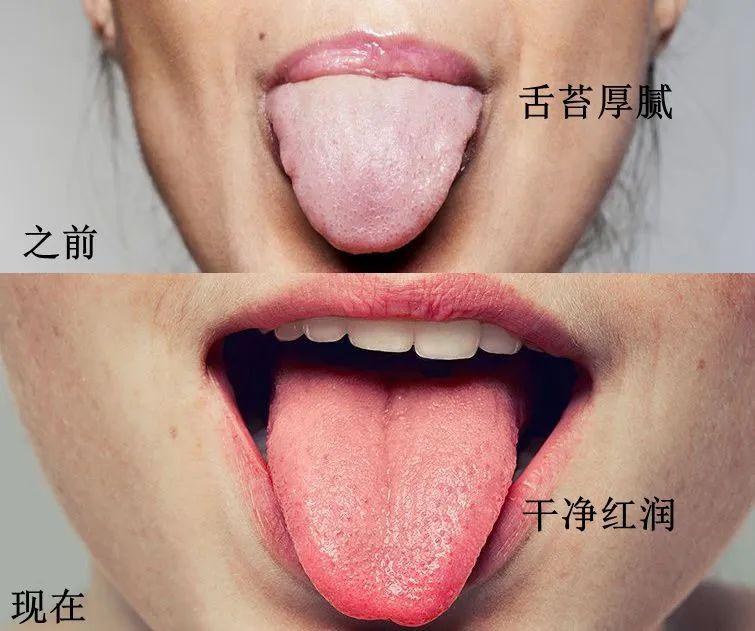 健康又充满生机舌头变得干净红润厚腻白苔也全没有了因为脾胃虚寒导致