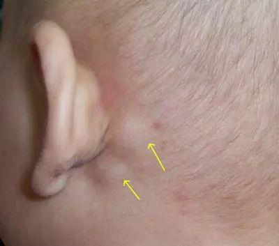 耳后乳突图片
