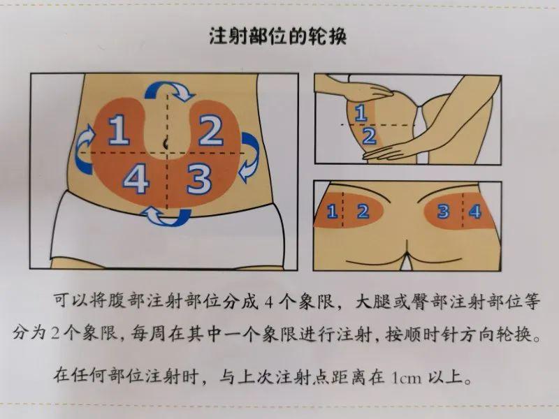 胰岛素注射9个步骤图片