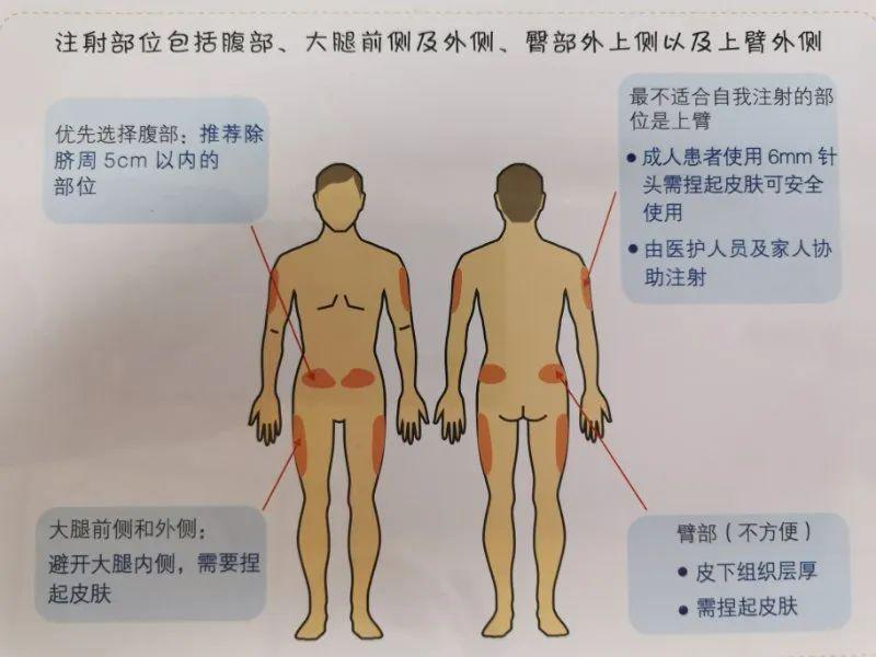 打胰岛素手臂位置图片图片