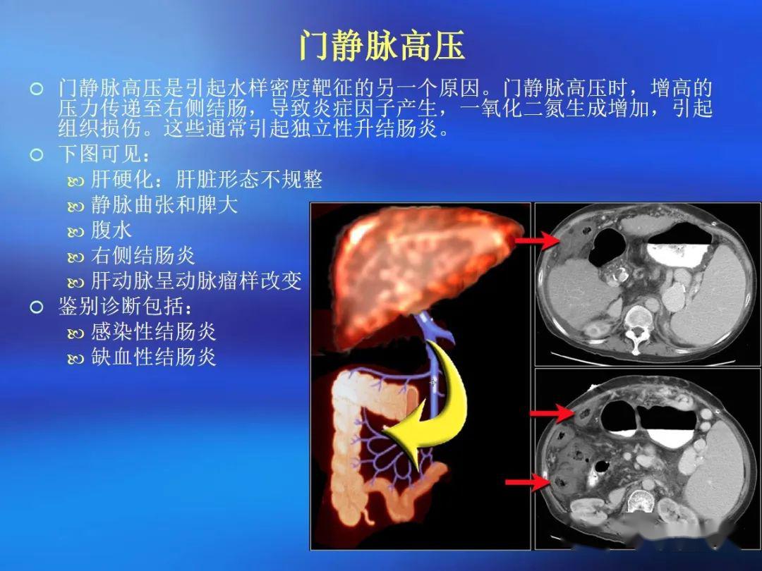 肠道壁增厚ct表现