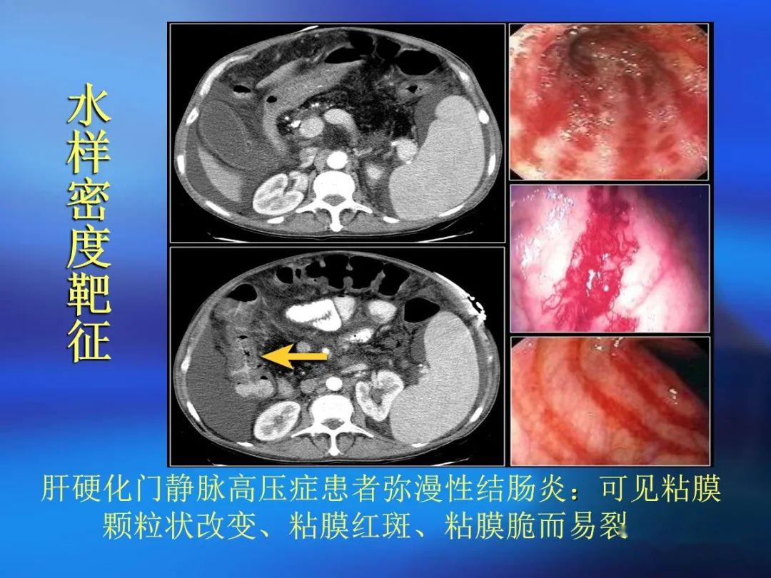 肠道壁增厚ct表现