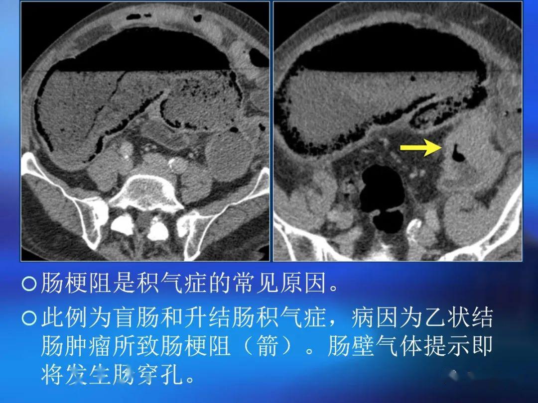 肠道壁增厚ct表现