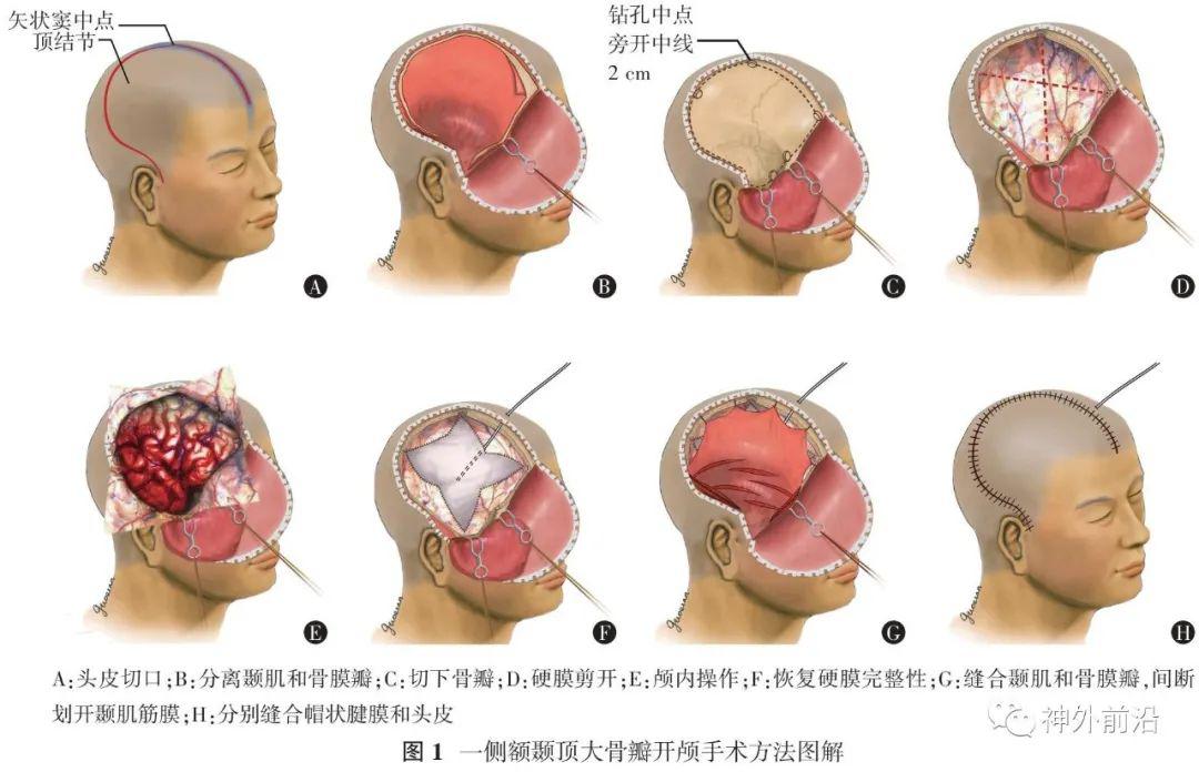 开颅步骤图片