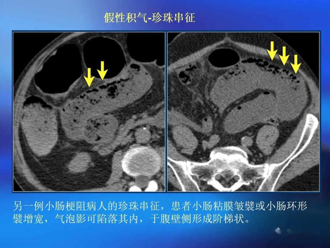 小肠ct分段解剖图图片