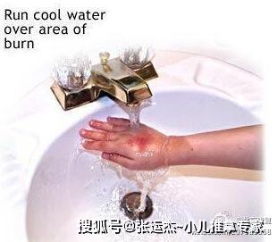 孩子|张运杰~小儿推拿专家：孩子被烫伤后，应该如何快速处理呢？