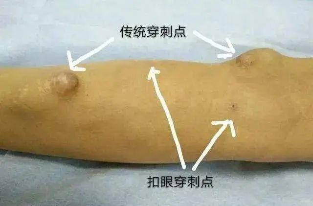 钝针穿刺究竟好在哪里