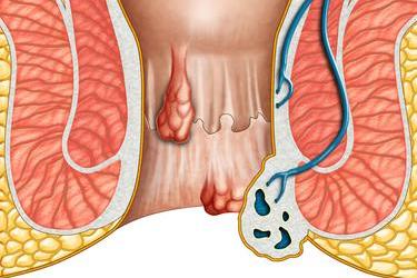 原创肛周脓肿的祸根或不外乎这3个排在第一很多妹子都经常犯