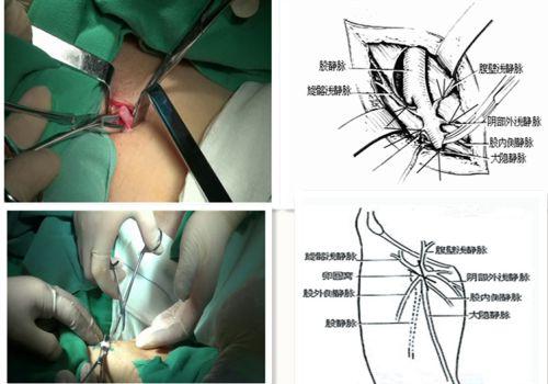 下肢静脉曲张手术图解图片