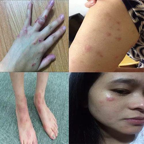 10年湿疹、皮炎有救了！西域千年古方，拔毒止痒，去疹！_消炎