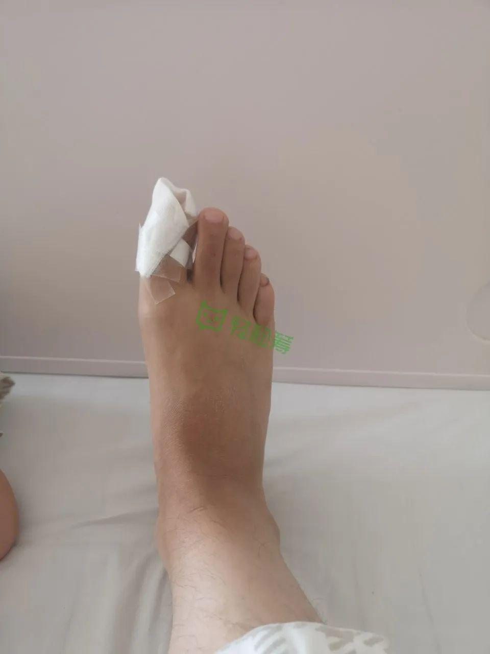 右足恶性黑色素瘤伴腿部肌肉及腹股淋巴结转移患者恳请得到援助.