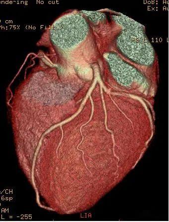 正常心脏ct造影图片图片