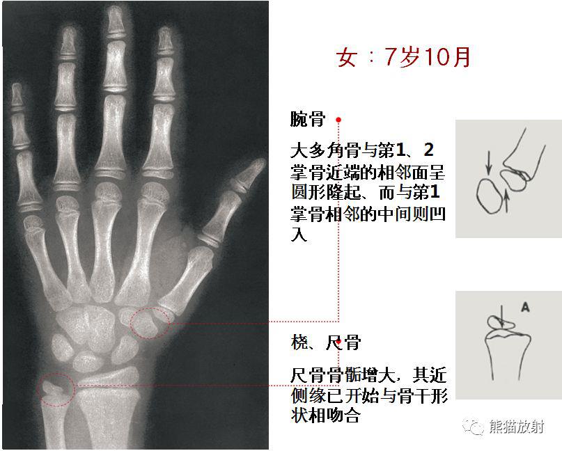 收藏丨骨龄图谱方便随时对照