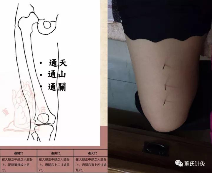 董氏奇穴针灸——失眠处方_睡眠