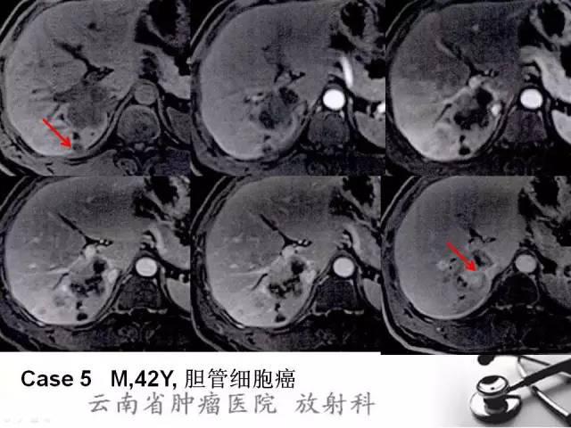 胆管细胞癌的ct及mri诊断