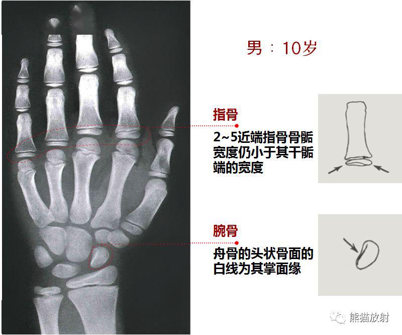 骨龄片子怎么看左手图片