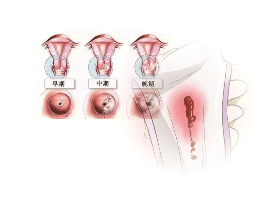 宫颈癌早期前兆图图片