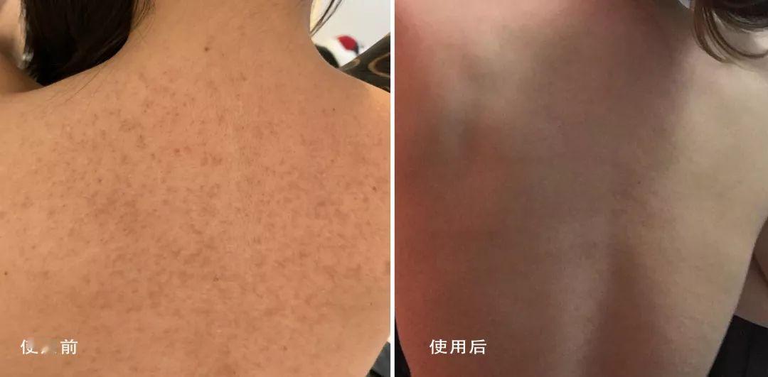 为什么o尿起鸡皮疙瘩(为什么尿急会起鸡皮疙瘩)