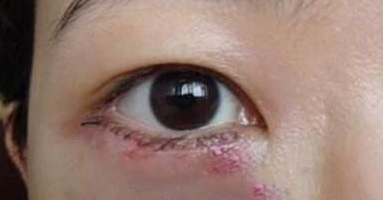 眼袋手术后遗症有哪些切眼袋术后注意事项是什么求实锤