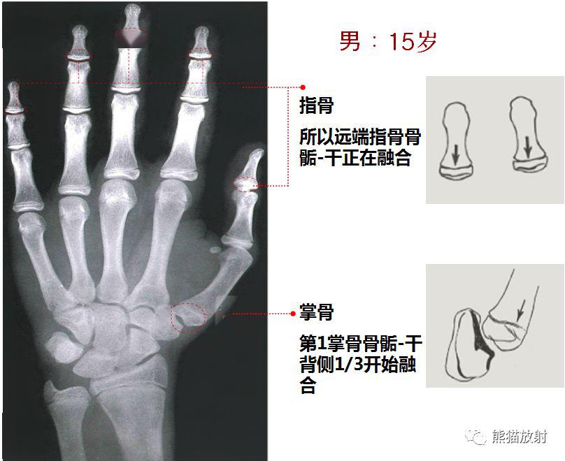 骨龄标准对照图 图谱图片