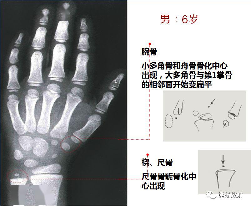 tw3骨龄对照表图片