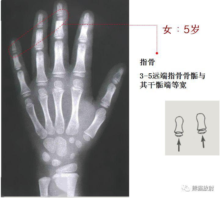 收藏丨骨龄图谱方便随时对照