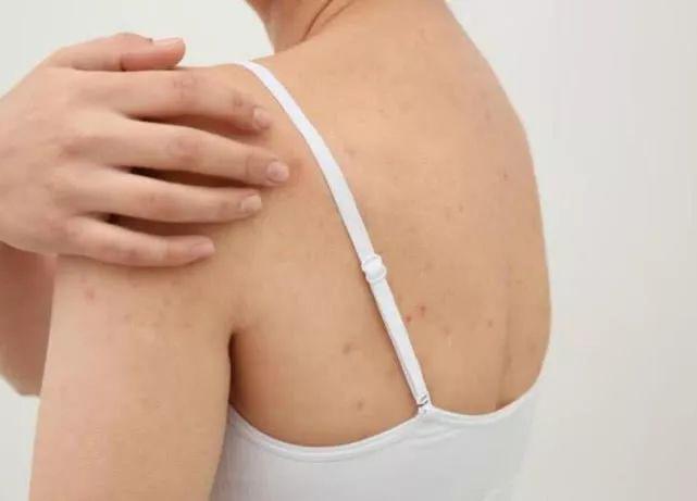 10年湿疹皮炎有救了西域千年古方拔毒止痒去疹