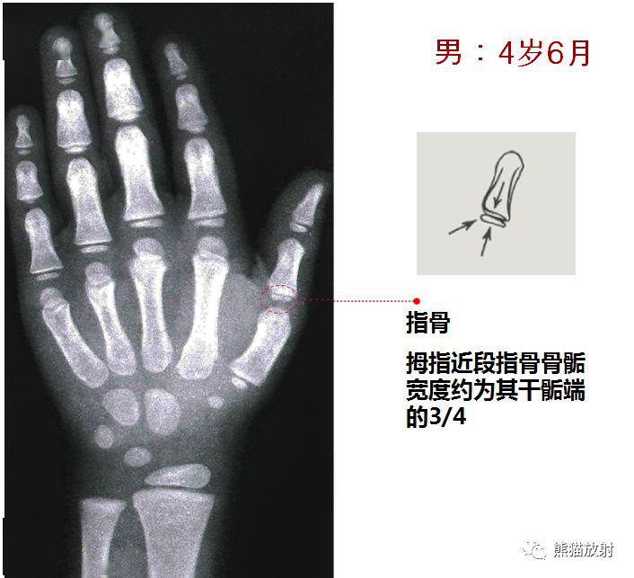 收藏丨骨齡圖譜方便隨時對照