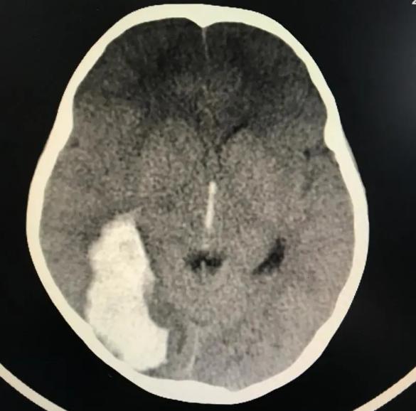 镇街医院急诊科,经过颅脑ct检查诊断为:右颞枕叶脑出血(血肿约35ml)