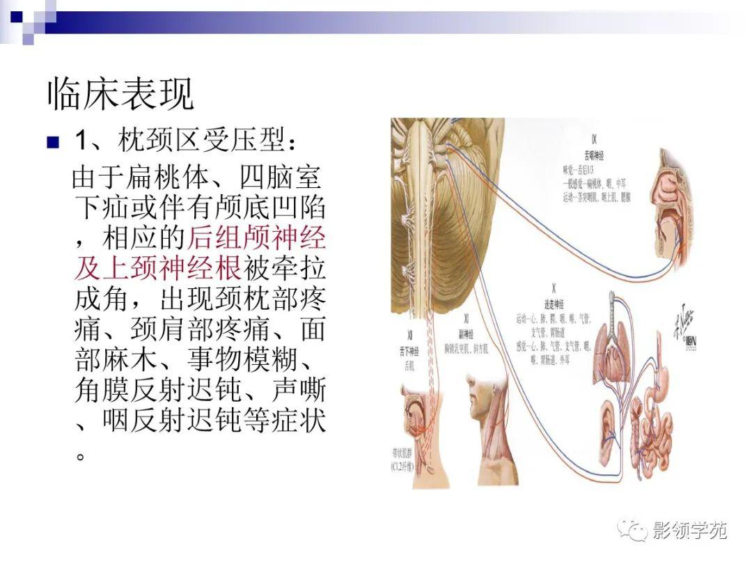 小脑扁桃体疝解剖图片