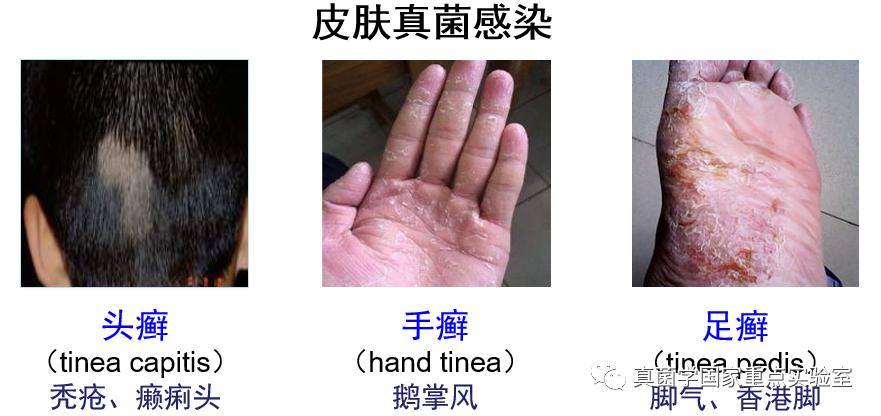 可能你马上就知道了——"癣",脚气,鹅掌风,瘌痢头都是由浅部真菌引起