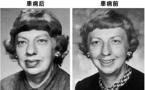 生长激素分泌型垂体瘤导致的远端肢体肥大患者,不仅会手脚,鼻子,嘴唇