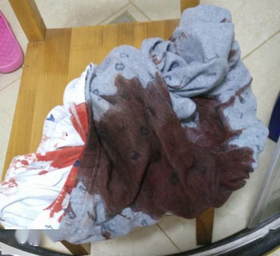 男童半夜血染床单元凶竟是直肠息肉便血联合门诊快速擒凶
