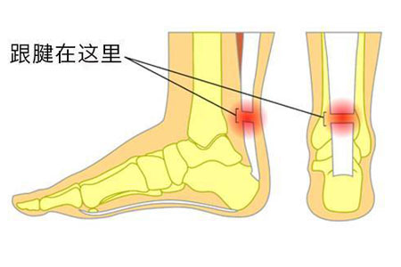 跟腱炎位置图图片