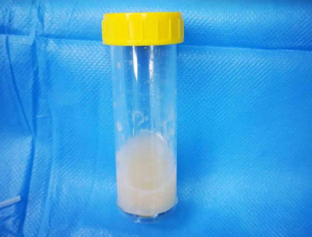 潍坊市妇幼保健院开启小儿支气管镜技术一例肺泡蛋白沉积症危重儿肺泡