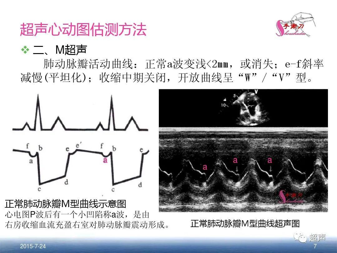 肺动脉高压的超声评估方法