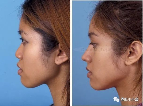 原创详解:人中沟是如何增加或者拖累颜值的|日本医美