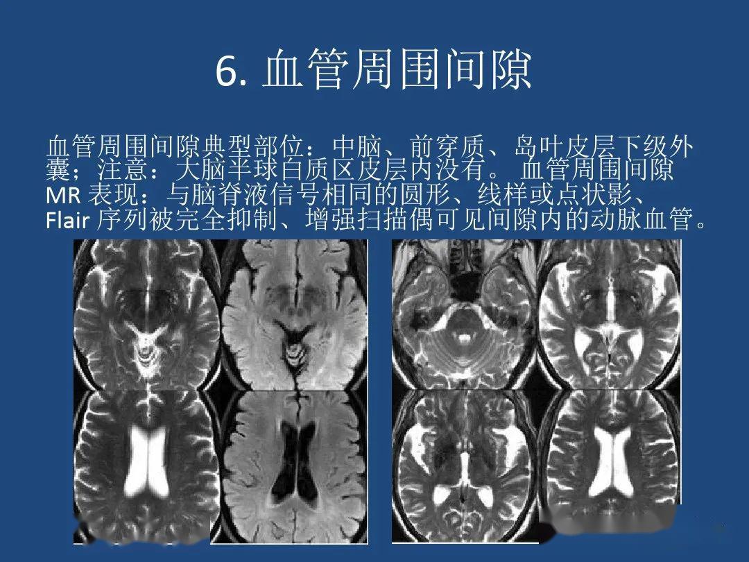 脑小血管病影像与临床七大要点
