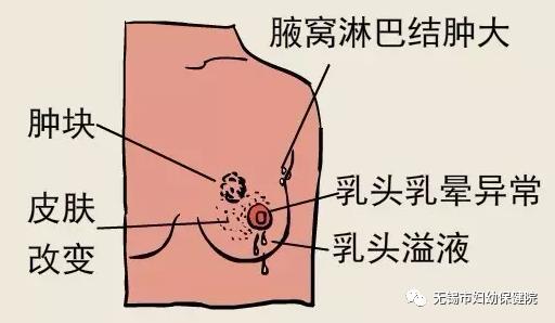 乳房淋巴结的位置图片图片